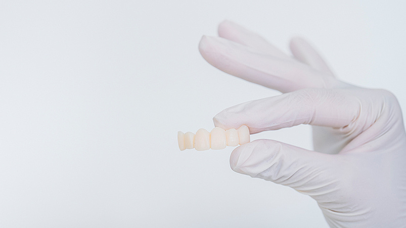 Lumineers (Veneerschalen)