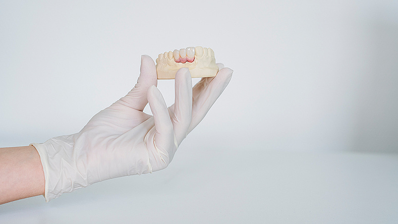 Vollkeramischer Zahnersatz